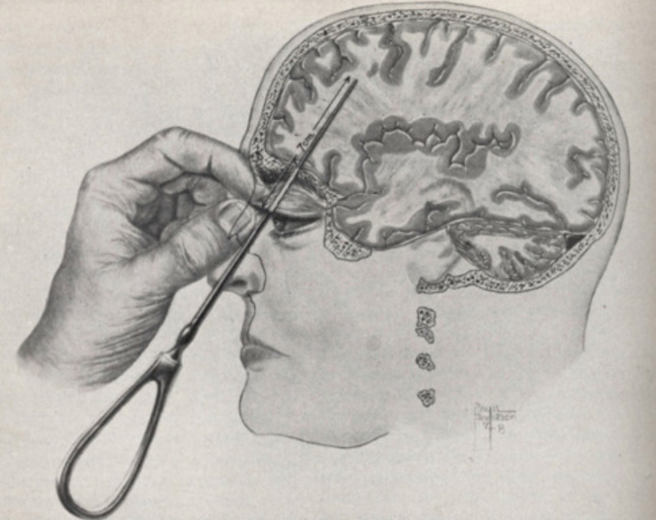Файл:Transocular Lobotomy.png